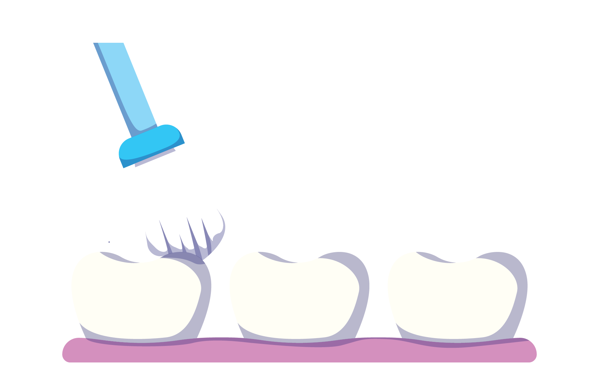 A Brush applying Fluoride to Exterior of Teeth